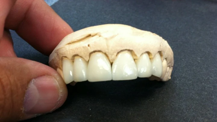 Close-up of a handcrafted dental bridge restoration