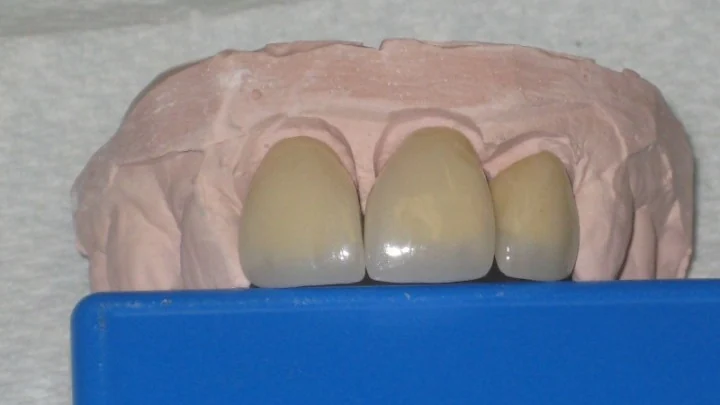 Dental restoration on a laboratory model